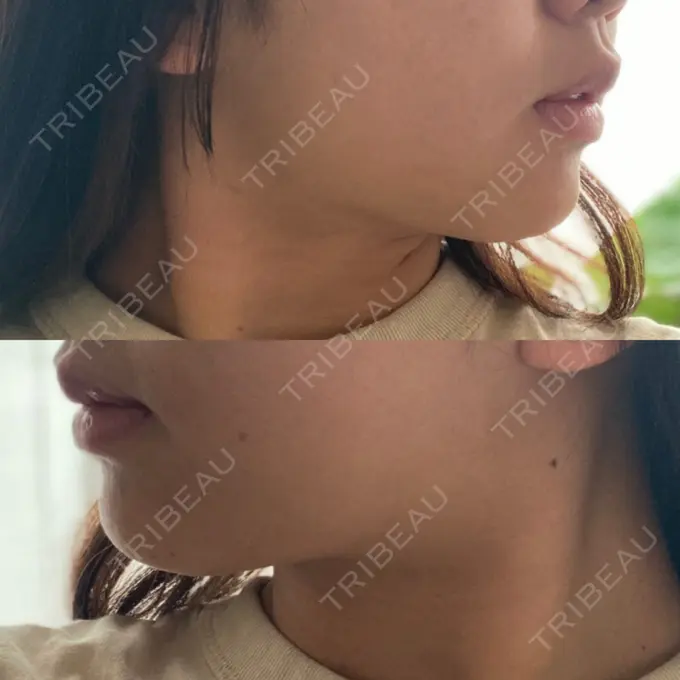 糸リフト / 脂肪吸引（顔） / ボトックス（エラ・小顔） 湘南美容クリニック 秋葉原院 DAY 52 メイン用