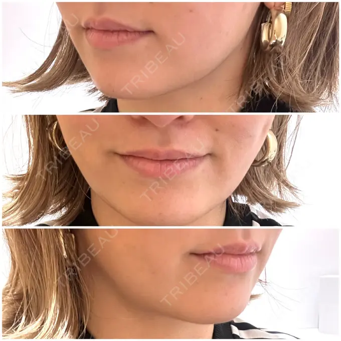 ジョールファット除去 / 脂肪吸引注射（顔） ziz CLINIC DAY 17 メイン用