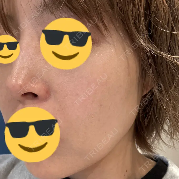 エレクトロポレーション / ルメッカ / ポテンツァ Otus Clinic 【オータスクリニック】 AFTER メイン用