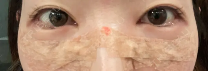 クマ治療 ジョウクリニック 大阪院 DAY 0 メイン用