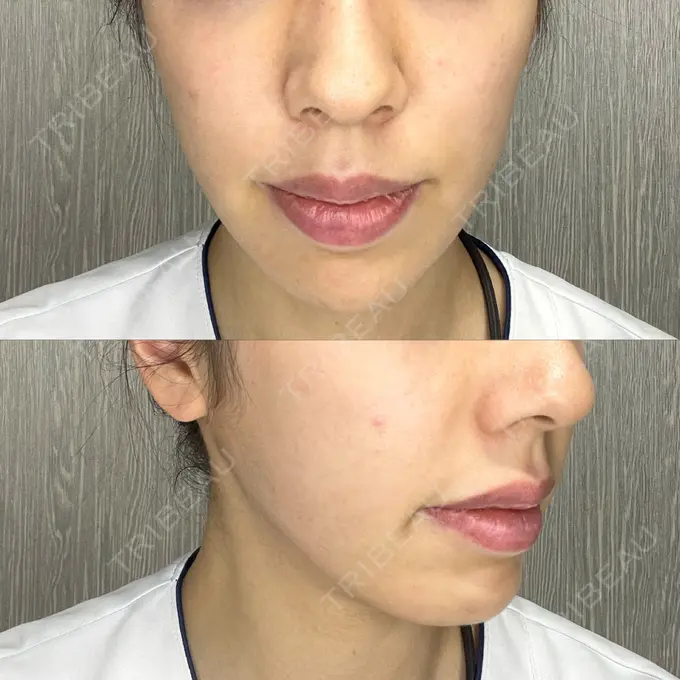 糸リフト / 脂肪吸引（顔） / ジョールファット除去 / ボトックス（あご） / ヒアルロン酸注入（あご） / ボトックス（エラ・小顔） RIVER CLINIC（リバークリニック） AFTER メイン用