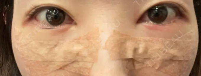 クマ治療 ジョウクリニック 大阪院 DAY 1 メイン用