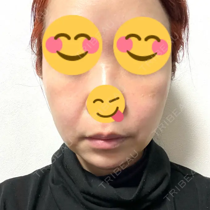 脂肪吸引（顔） / 下まぶたたるみ取り / ボトックス（エラ・小顔） / ハイフ（顔） TCB東京中央美容外科 梅田大阪駅前院 DAY 8 メイン用