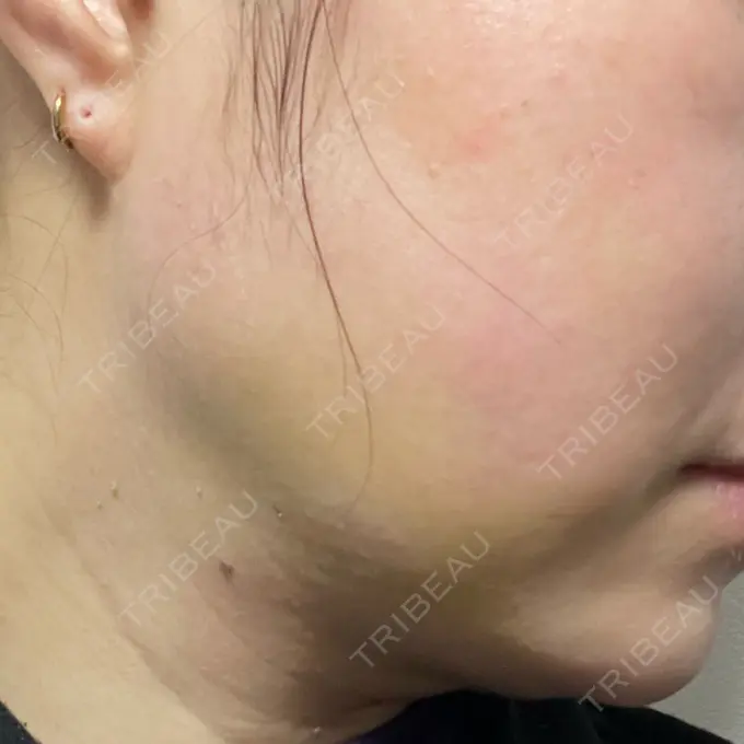 脂肪吸引（顔） / 下まぶたたるみ取り / ボトックス（エラ・小顔） / ハイフ（顔） TCB東京中央美容外科 梅田大阪駅前院 DAY 8 メイン用