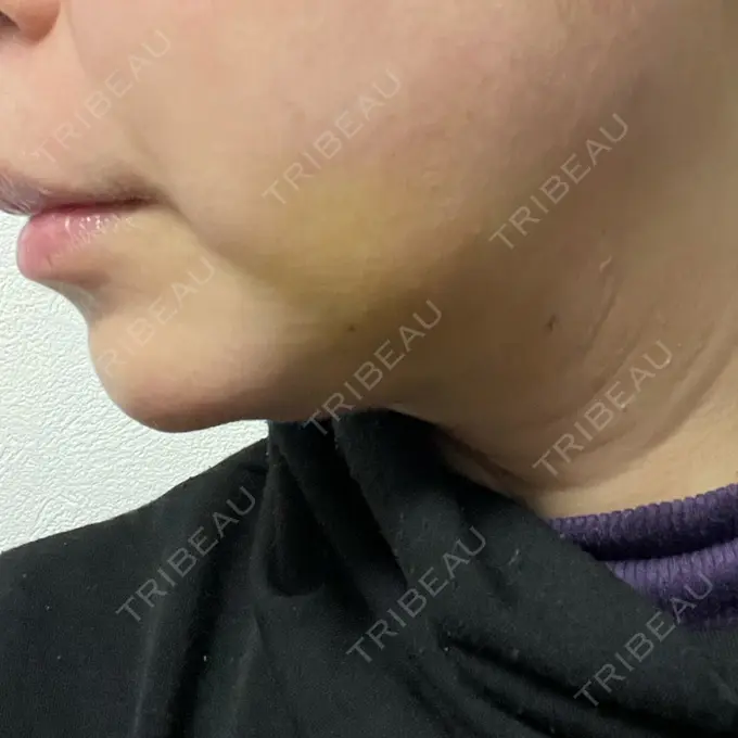 脂肪吸引（顔） / 下まぶたたるみ取り / ボトックス（エラ・小顔） / ハイフ（顔） TCB東京中央美容外科 梅田大阪駅前院 DAY 8 メイン用