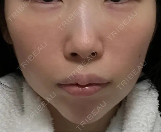 ハイフ（顔） 椿クリニック 心斎橋院 AFTER メイン用
