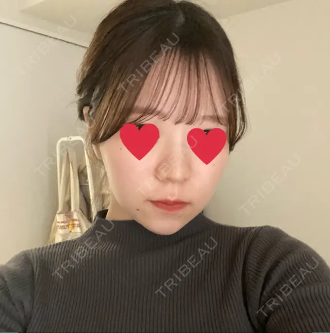 バッカルファット除去 / 脂肪吸引（顔） / ジョールファット除去 / ボトックス（エラ・小顔） 東京シンデレラ美容外科 池袋院 DAY 111 メイン用