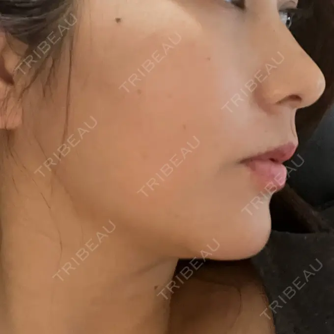 糸リフト Ginza 78 Clinic DAY 0 メイン用