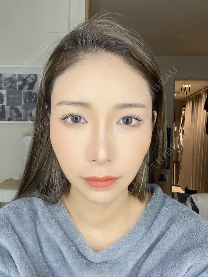 額を丸く / 脂肪注入（額） / 脂肪注入（目の下） ルーチェクリニック 銀座院 DAY 25 メイン用