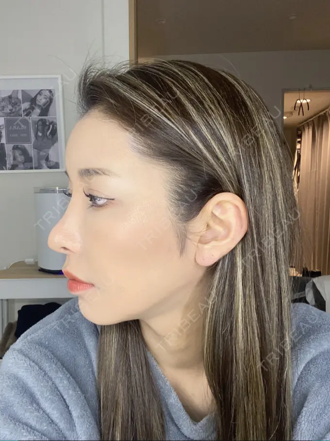 額を丸く / 脂肪注入（額） / 脂肪注入（目の下） ルーチェクリニック 銀座院 DAY 25 メイン用