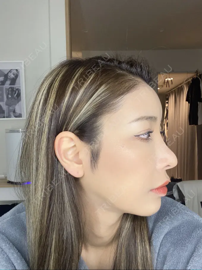 額を丸く / 脂肪注入（額） / 脂肪注入（目の下） ルーチェクリニック 銀座院 DAY 25 メイン用