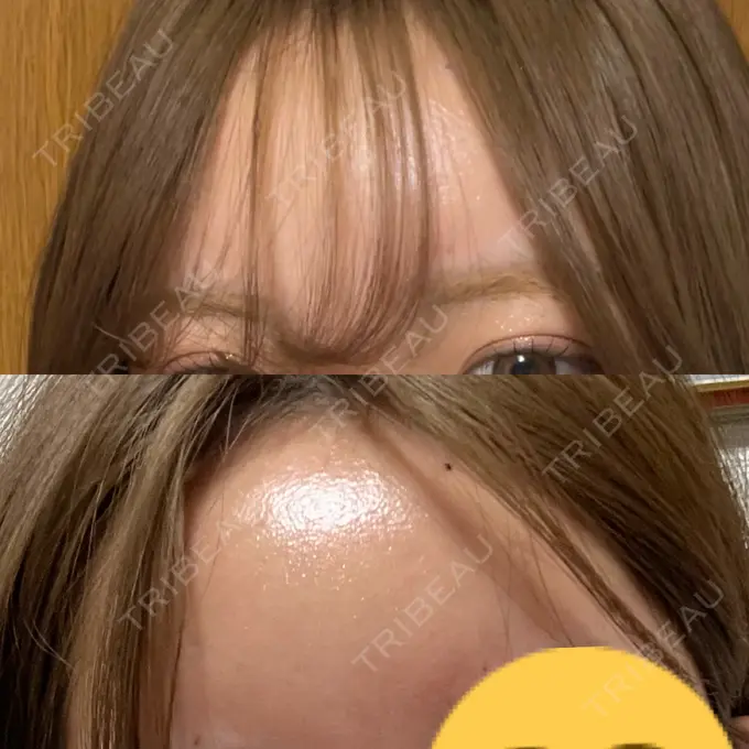 ヒアルロン酸注入（額） / ヒアルロン酸注入（こめかみ） LA CLEF CLINIC（ラクレクリニック） AFTER メイン用