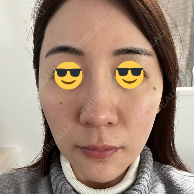 シミ取りレーザー BBC表参道院 DAY 1 メイン用