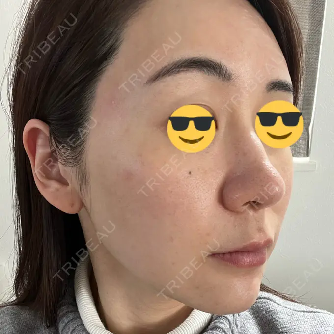 シミ取りレーザー BBC表参道院 DAY 1 メイン用