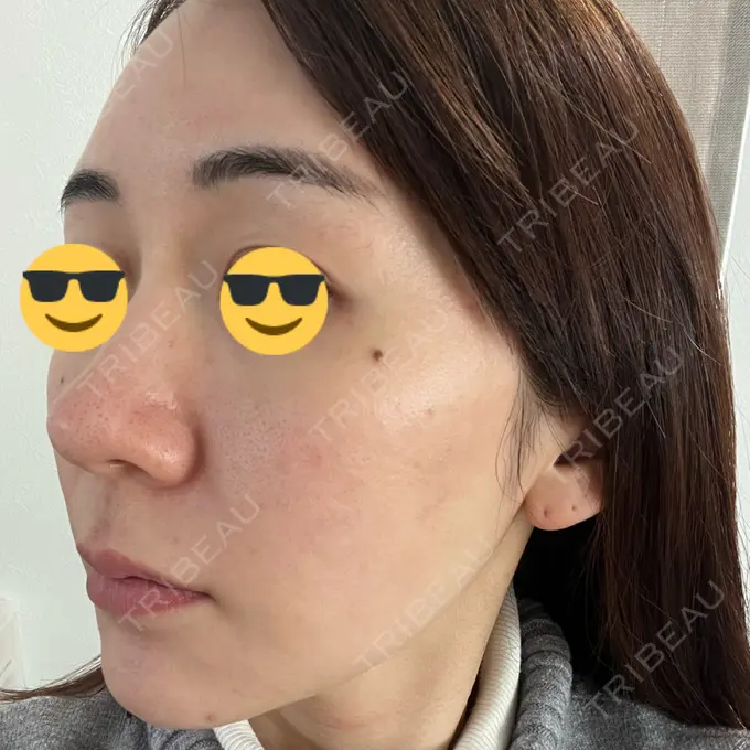 シミ取りレーザー BBC表参道院 DAY 1 メイン用