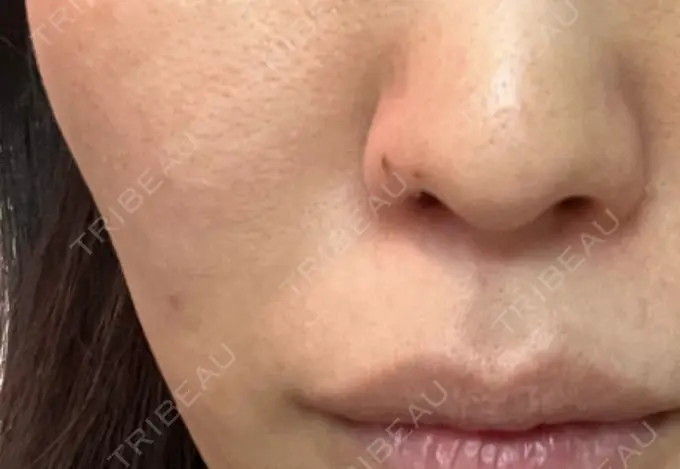 エレクトロポレーション ハナビューティークリニック AFTER メイン用