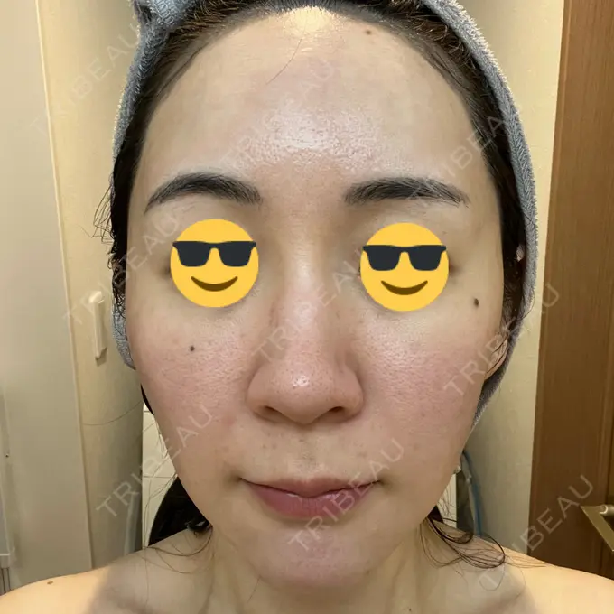 シミ取りレーザー BBC表参道院 DAY 1 メイン用