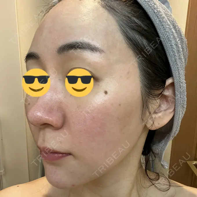 シミ取りレーザー BBC表参道院 DAY 1 メイン用