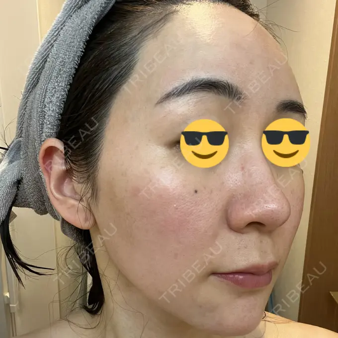 シミ取りレーザー BBC表参道院 DAY 1 メイン用