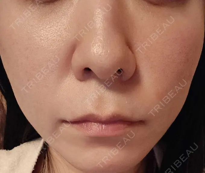 その他（肌） 湘南美容クリニック 仙台院 DAY 123 メイン用