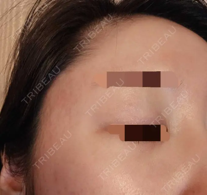 その他（肌） 湘南美容クリニック 仙台院 DAY 123 メイン用