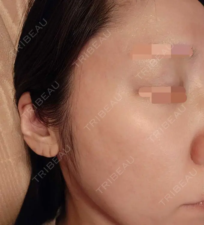 その他（肌） 湘南美容クリニック 仙台院 DAY 123 メイン用