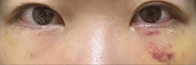 クマ治療 / 脂肪注入（目の下） アリエル美容クリニック 大宮院 DAY 6 メイン用