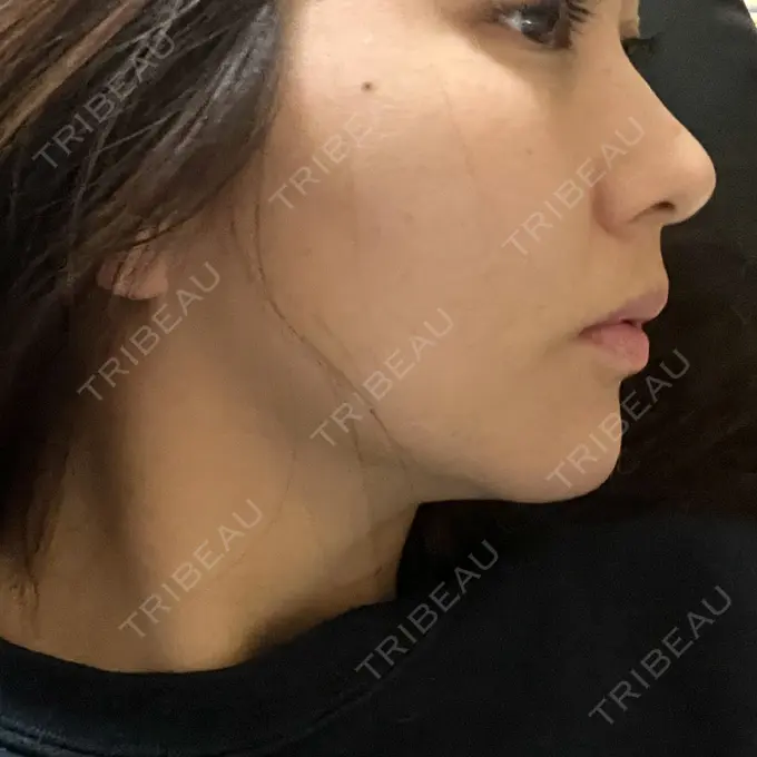 糸リフト Ginza 78 Clinic AFTER メイン用