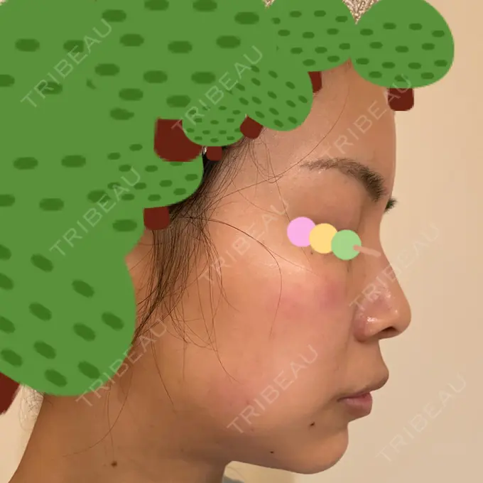 イオン導入 / ピーリング（ハリ・ツヤ） / ルメッカ ルラ美容クリニック 神戸院 DAY 1 メイン用