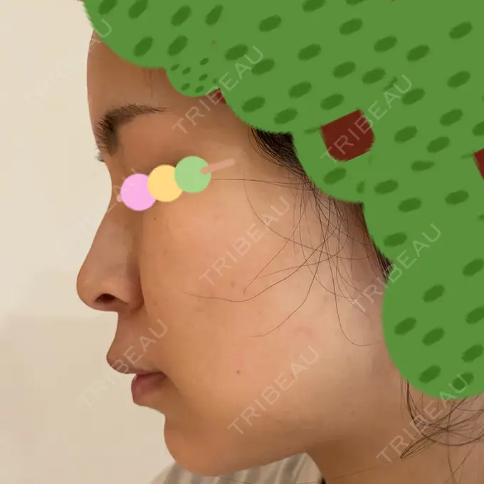 イオン導入 / ピーリング（ハリ・ツヤ） / ルメッカ ルラ美容クリニック 神戸院 DAY 2 メイン用