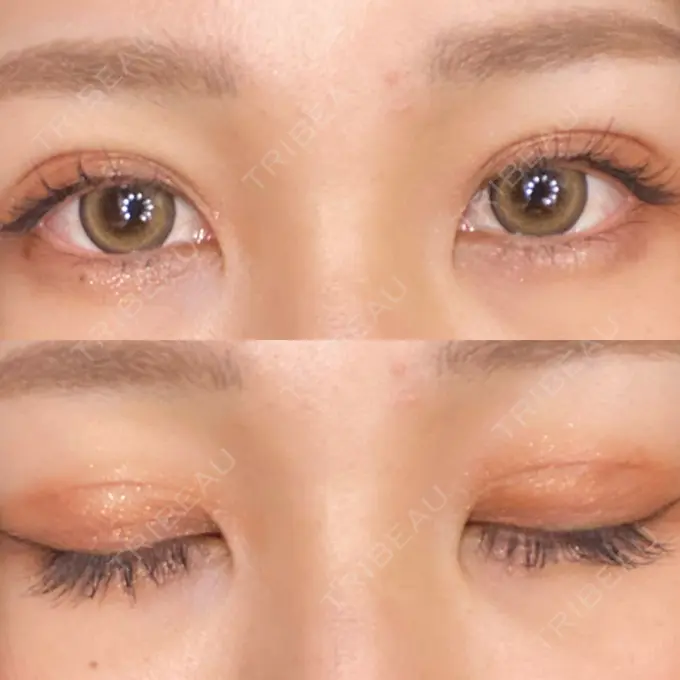 二重埋没 城本クリニック 大阪院 DAY 23 メイン用