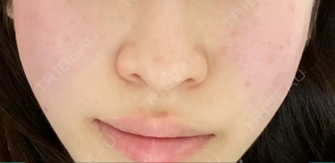 ピコレーザートーニング（美白・肝斑） SIGNATURE CLINIC 銀座 DAY 1 メイン用