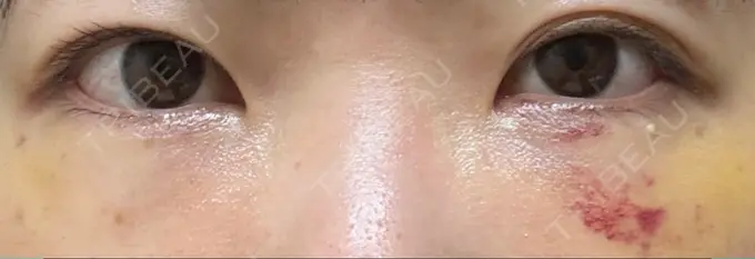 クマ治療 / 脂肪注入（目の下） アリエル美容クリニック 大宮院 DAY 7 メイン用