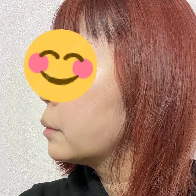 脂肪吸引（顔） / 下まぶたたるみ取り / ボトックス（エラ・小顔） / ハイフ（顔） TCB東京中央美容外科 梅田大阪駅前院 DAY 13 メイン用