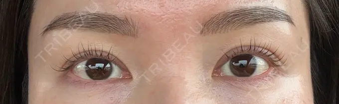 二重埋没 東京シンデレラ美容外科 大宮院 DAY 62 メイン用