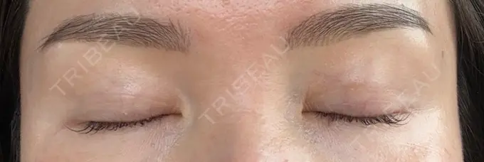 二重埋没 東京シンデレラ美容外科 大宮院 DAY 62 メイン用