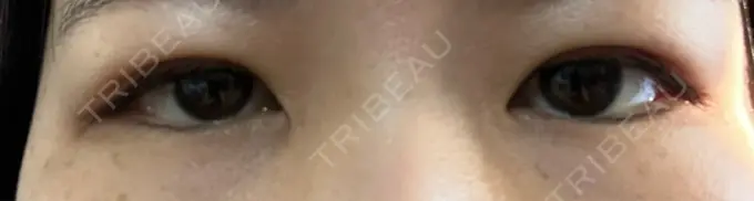 二重埋没 日本ウェルネス再生クリニック DAY 9 メイン用