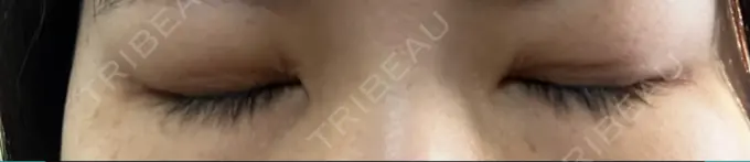 二重埋没 日本ウェルネス再生クリニック DAY 9 メイン用