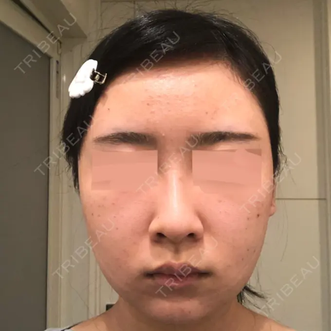 バッカルファット除去 / 脂肪吸引（顔） / ヒアルロン酸注入（鼻） / ボトックス（あご） / 水光注射（ハリ・美肌） / ボトックス（エラ・小顔） / ボトックス（口角） / 白玉点滴・注射 エートップ美容整形外科 DAY 4 メイン用