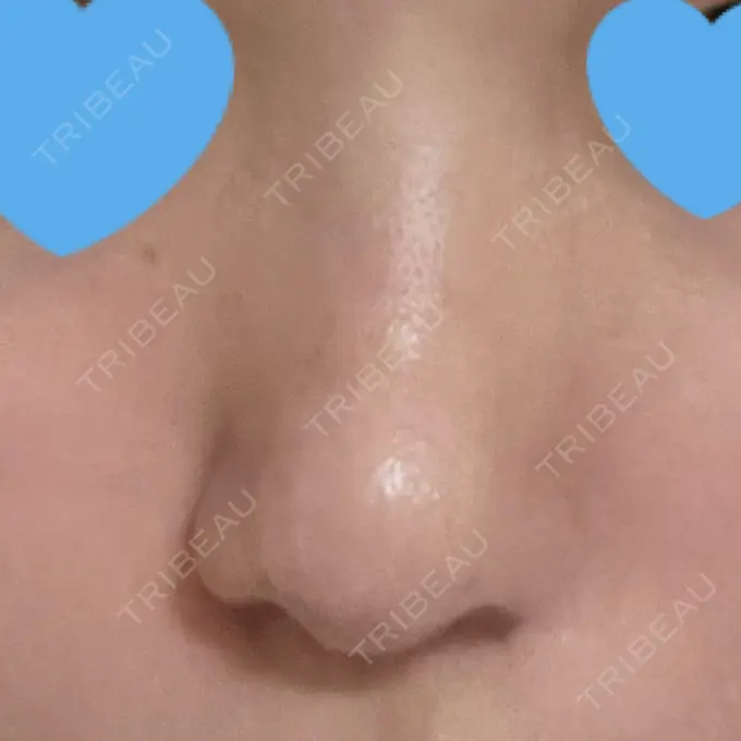 鼻尖形成（切開） / 小鼻縮小（切開） / 軟骨移植 / 鼻孔縁下降 / ヒアルロン酸注入（鼻） ziz CLINIC AFTER メイン用