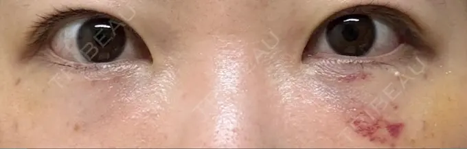 クマ治療 / 脂肪注入（目の下） アリエル美容クリニック 大宮院 DAY 8 メイン用