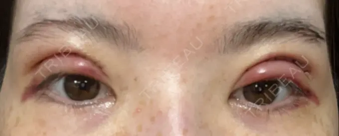 二重切開 / 上まぶたたるみ取り / 眼瞼下垂（非切開） WOM CLINIC GINZA （ワム クリニック ギンザ） DAY 2 メイン用