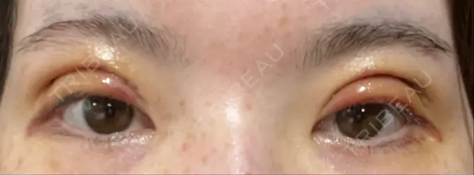 二重切開 / 上まぶたたるみ取り / 眼瞼下垂（非切開） WOM CLINIC GINZA （ワム クリニック ギンザ） DAY 3 メイン用