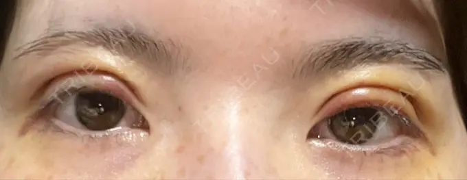 二重切開 / 上まぶたたるみ取り / 眼瞼下垂（非切開） WOM CLINIC GINZA （ワム クリニック ギンザ） DAY 4 メイン用