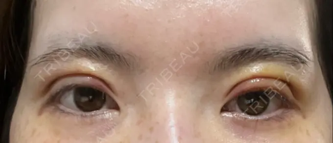 二重切開 / 上まぶたたるみ取り / 眼瞼下垂（非切開） WOM CLINIC GINZA （ワム クリニック ギンザ） DAY 5 メイン用