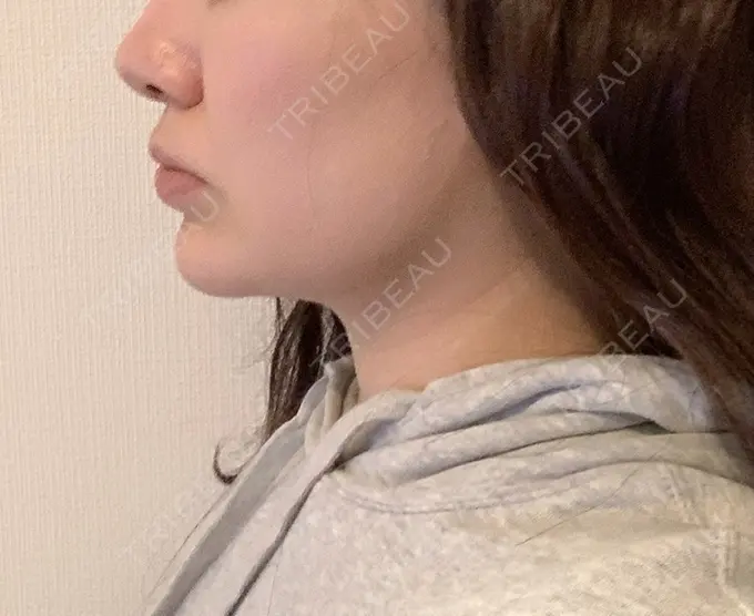 脂肪吸引（顔） / ボトックス（あご） / ヒアルロン酸注入（唇） / ヒアルロン酸溶解 藤・ナチュレ美容クリニック 恵比寿院 DAY 22 メイン用