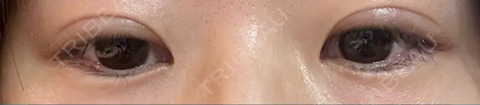 二重埋没 銀座S美容・形成外科クリニック DAY 113 メイン用