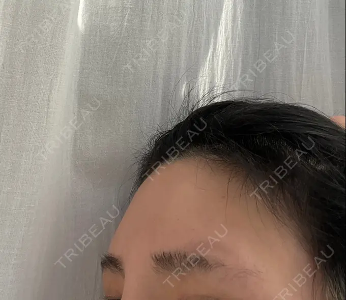 ボトックス（あご） / ヒアルロン酸注入（あご） / ボトックス（エラ・小顔） / ヒアルロン酸注入（額） / その他（口元） 新未来クリニック DAY 19 メイン用