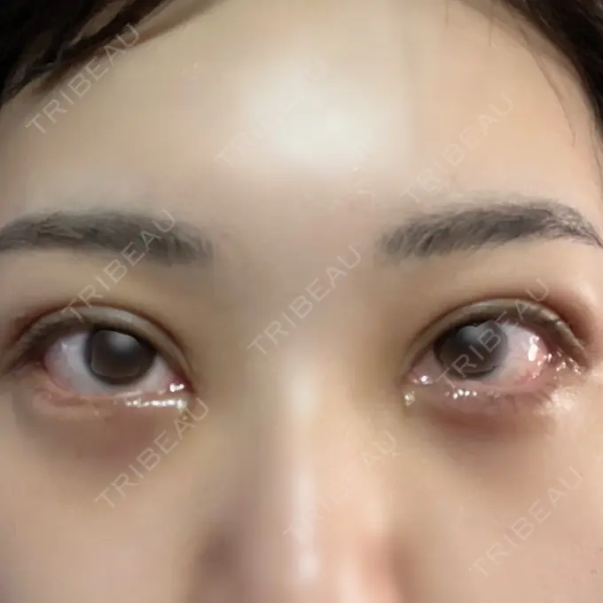 二重埋没 / 目頭切開 / クマ治療 / 目尻切開 / タレ目形成・グラマラスライン（切開） EMMA CLINIC（エマクリニック） DAY 23 メイン用