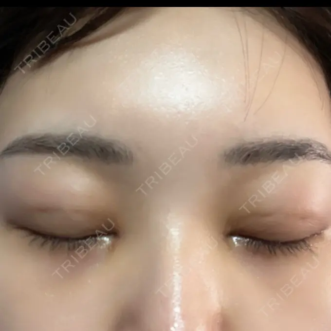 二重埋没 / 目頭切開 / クマ治療 / 目尻切開 / タレ目形成・グラマラスライン（切開） EMMA CLINIC（エマクリニック） DAY 23 メイン用